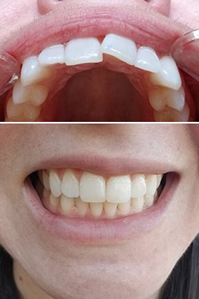 Candid Straighten Your Teeth In An Average Of 6 Months