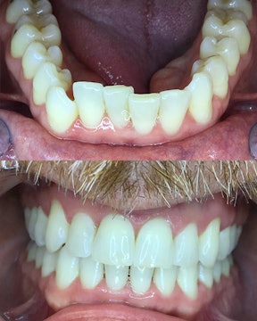 Candid patient before and after treatment - 2